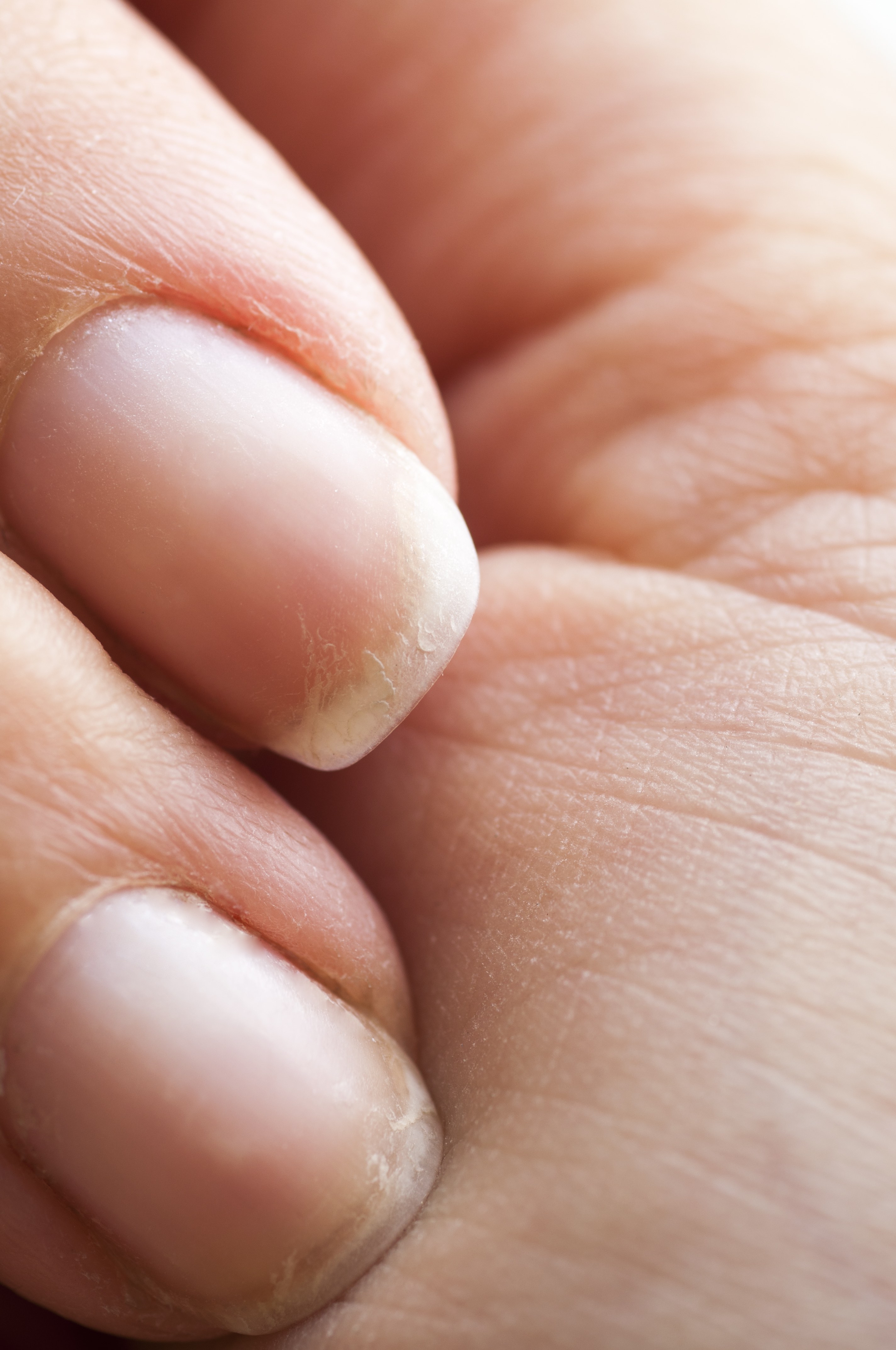 Dehydration tops list of nail complaints among Brits